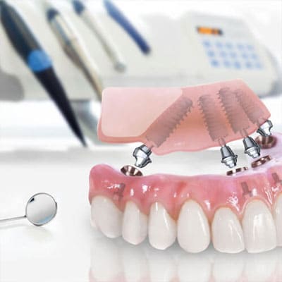 All-on-4 Implants