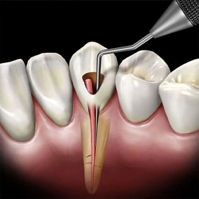 Root Canal Treatment
